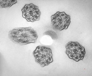 F,5y. | immotile cilia syndrome - trachea